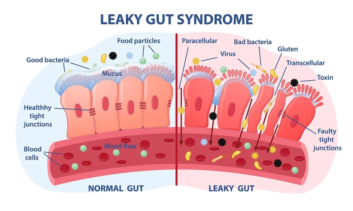 Leaky Gut Management